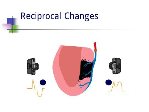 12 Lead ECGs Ischemia Injury & Infarction Part 3