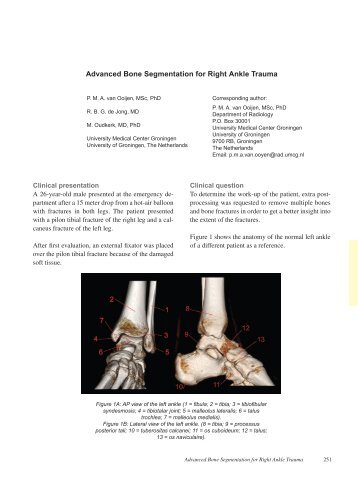 department calcaneus postprocessing