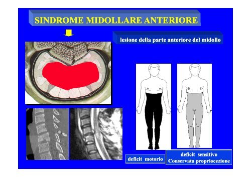 CLASSIFICAZIONE NEUROLOGICA STANDARD NEI TRAUMI MIDOLLARI