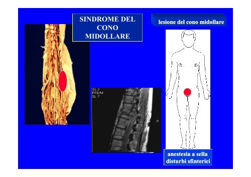 CLASSIFICAZIONE NEUROLOGICA STANDARD NEI TRAUMI MIDOLLARI