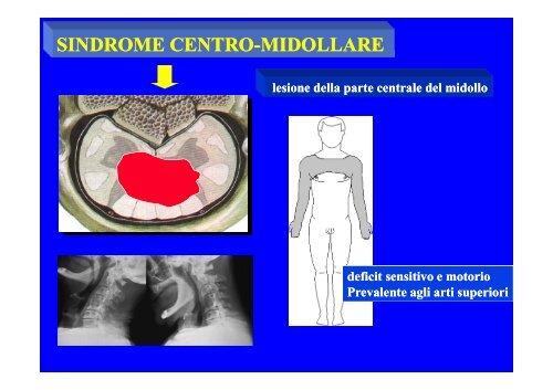 CLASSIFICAZIONE NEUROLOGICA STANDARD NEI TRAUMI MIDOLLARI