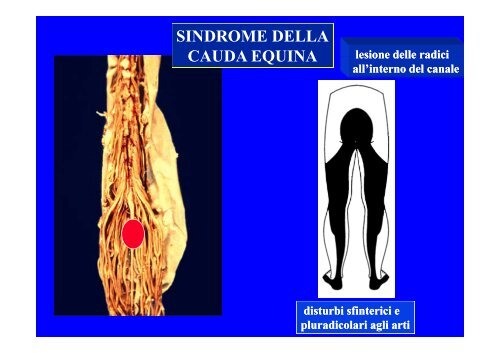 CLASSIFICAZIONE NEUROLOGICA STANDARD NEI TRAUMI MIDOLLARI