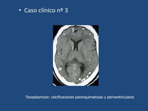 Calcificaciones cerebrales Diagnósticos Diferenciales