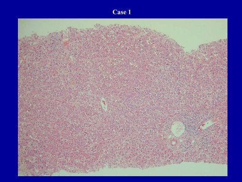 Acute Hepatitis Including Acute Liver Failure