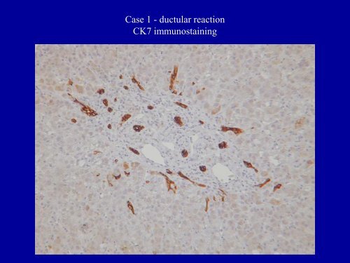 Acute Hepatitis Including Acute Liver Failure