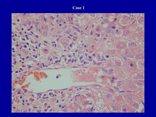 Acute Hepatitis Including Acute Liver Failure