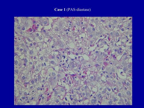 Acute Hepatitis Including Acute Liver Failure