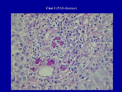 Acute Hepatitis Including Acute Liver Failure