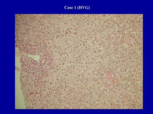 Acute Hepatitis Including Acute Liver Failure