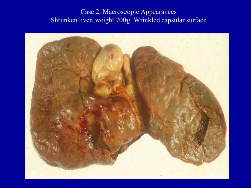 Acute Hepatitis Including Acute Liver Failure