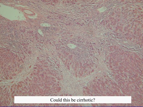 Acute Hepatitis Including Acute Liver Failure