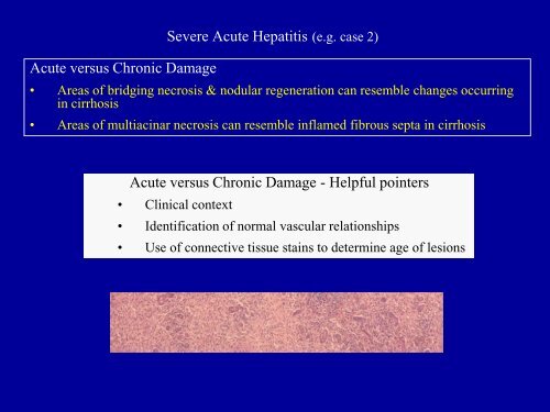 Acute Hepatitis Including Acute Liver Failure