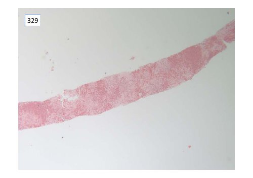 National Liver Histopathology EQA Scheme