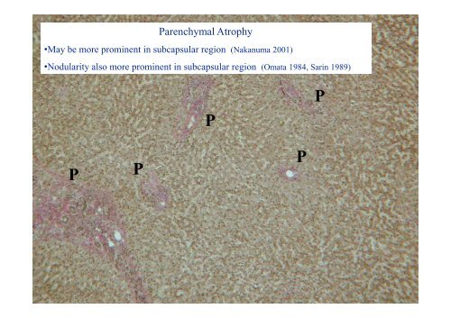 and Incomplete Septal Cirrhosis