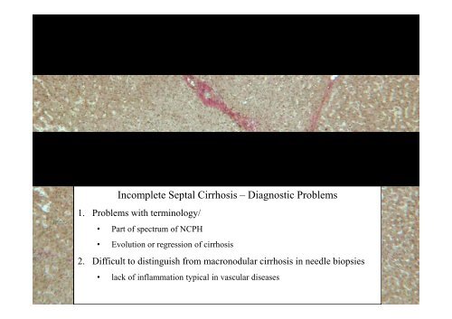 and Incomplete Septal Cirrhosis