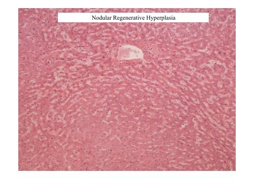 and Incomplete Septal Cirrhosis