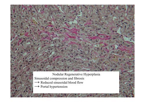 and Incomplete Septal Cirrhosis