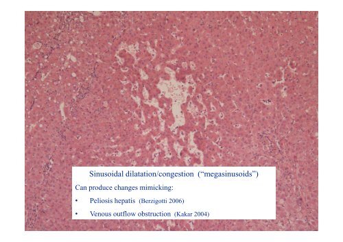 and Incomplete Septal Cirrhosis