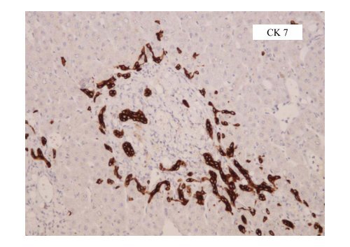 and Incomplete Septal Cirrhosis