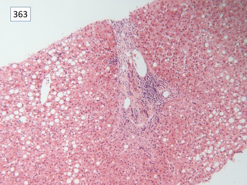 National Liver Histopathology EQA Scheme