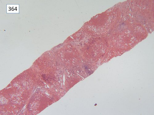 National Liver Histopathology EQA Scheme