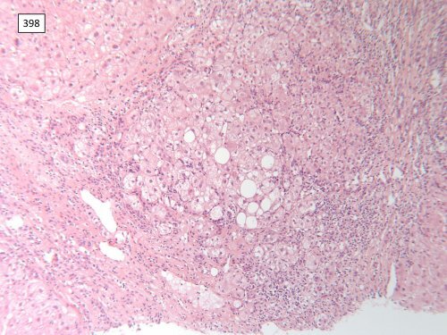 National Liver Histopathology EQA Scheme