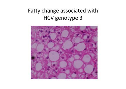 Fatty liver disease - Virtual Pathology at the University of Leeds