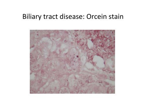 Fatty liver disease - Virtual Pathology at the University of Leeds