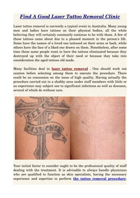 Find A Good Laser Tattoo Removal Clinic