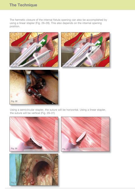VAAFT: Video-Assisted Anal Fistula Treatment - Dr. Piercarlo Meinero
