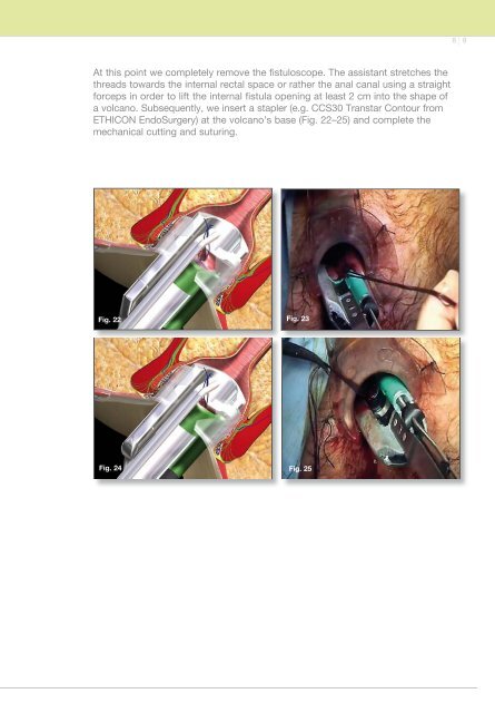 VAAFT: Video-Assisted Anal Fistula Treatment - Dr. Piercarlo Meinero