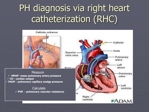 Pulmonary Hypertension