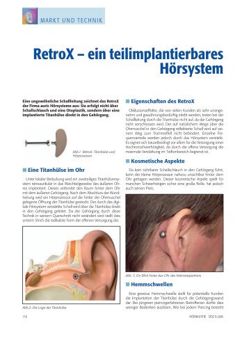 Retro X - ein teilimplantierbares Hörsystem