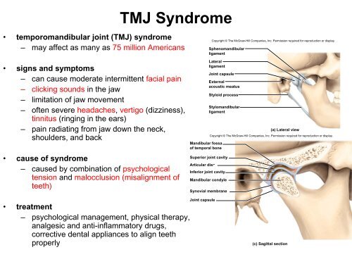 Temporal Mandibular Joint