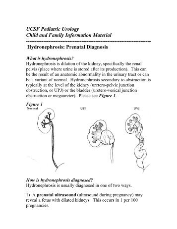 Hydronephrosis: Prenatal Diagnosis - UCSF Department of Urology