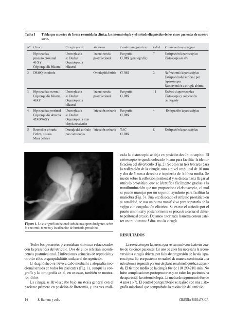 Resección laparoscópica del utrículo prostático en niños
