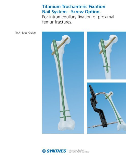 Comparison of sub trochanteric femur fracture treatment with intra  medullary proximal femur nail versus proximal femur nail with trochanteric  support plate - Indian J Orthop Surg
