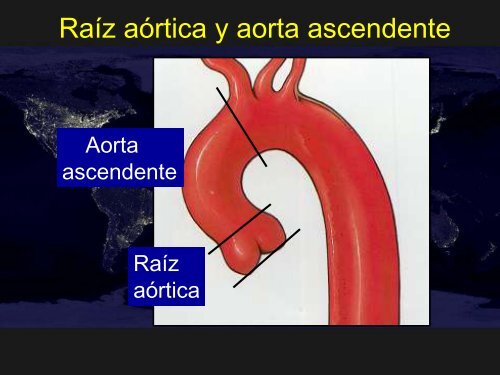 Raíz aórtica dilatada y aorta ascendente asintomáticas