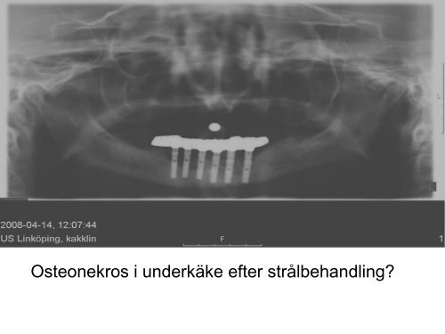 Osteonekros i underkäke efter strålbehandling?