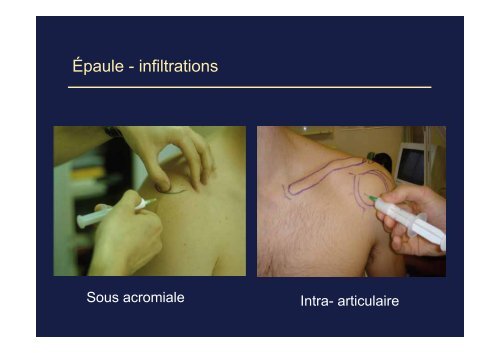 Les tendinopathies du membre supérieur