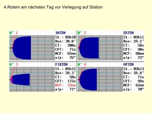 Milzhämatom bei Thrombopathie