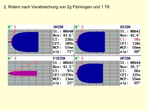 Milzhämatom bei Thrombopathie