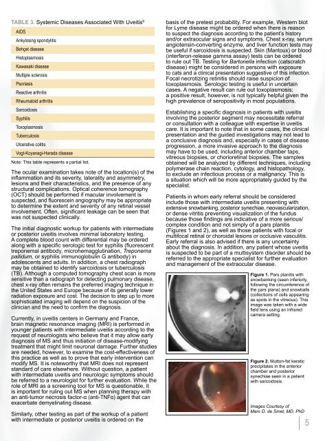 NONINFECTIOUS UVEITIS INVOLVING THE POSTERIOR SEGMENT