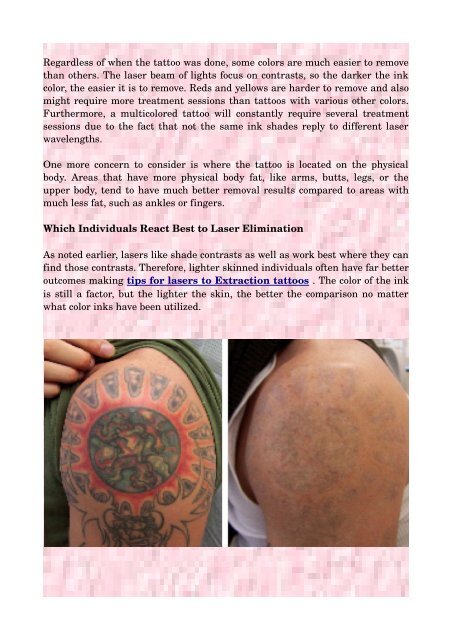 How To Have A Successful Laser Tattoo Removal