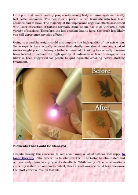 How To Have A Successful Laser Tattoo Removal