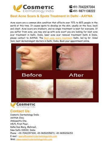 Best Acne Scars Treatment Delhi India – Aayna Clinic