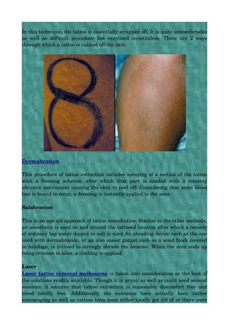 Want To Obtain That Tattoo Removal?