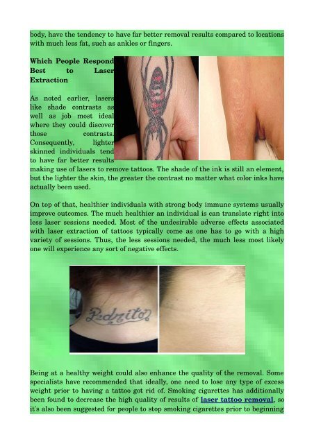 The Best Ways To Have An Effective Laser Tattoo Removal
