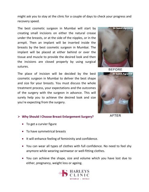 Some FAQs About Breast Enlargement Surgery