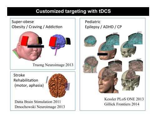 Direct Current Stimulation (HD-tDCS)